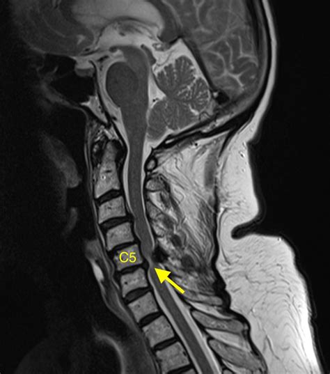 Cervical myelopathy results from compression of the spinal cord in the neck (cervical area of the spine). . Cervical spinal stenosis with myelopathy icd10